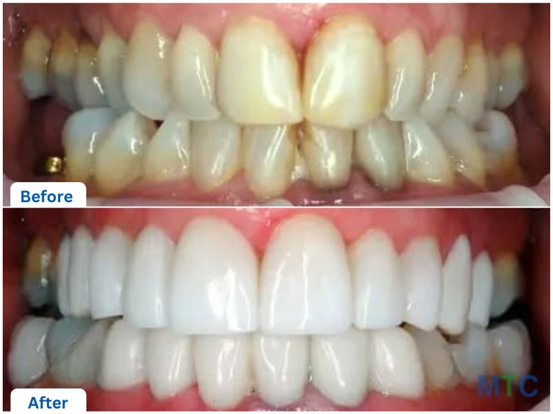 Dental Veneers in Bali, Before and After image