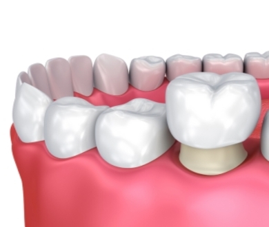 Zirconia Crowns