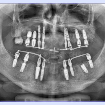 Immediate Implants: Intraoral Welding & Conometric Prosthesis