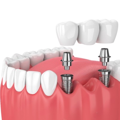 Implant Bridge