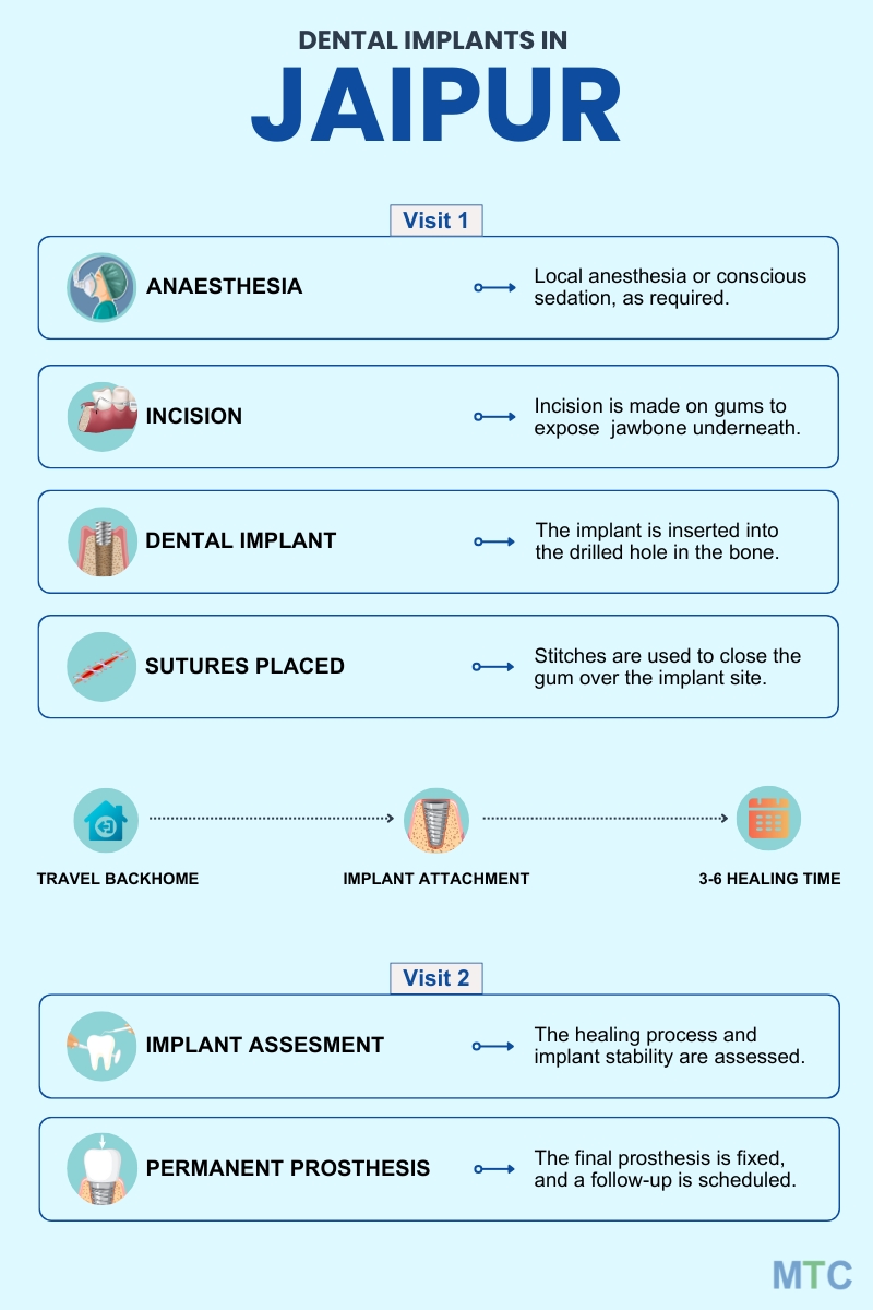 step by step procedure for dental implants in Jaipur