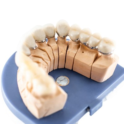 Dental model with PFM crowns