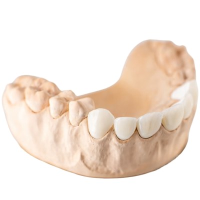 Dental model with porcelain crowns