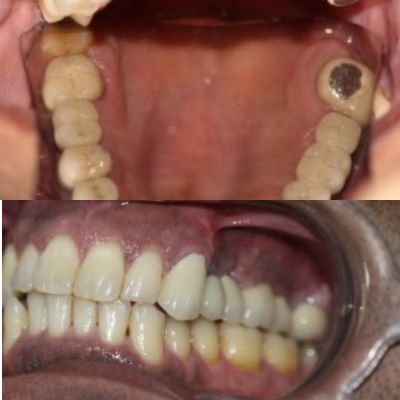 Dental Implants with Bilateral Sinus Lift along with Ridge Split