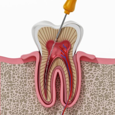 Root Canal Treatment