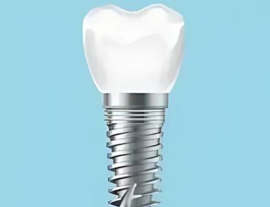 titanium implant