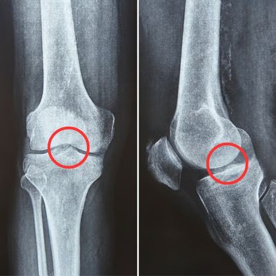 knee arthritis