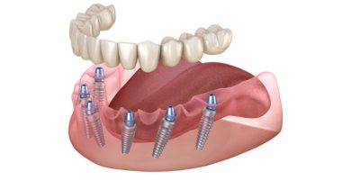 All on 6 Dental Implants