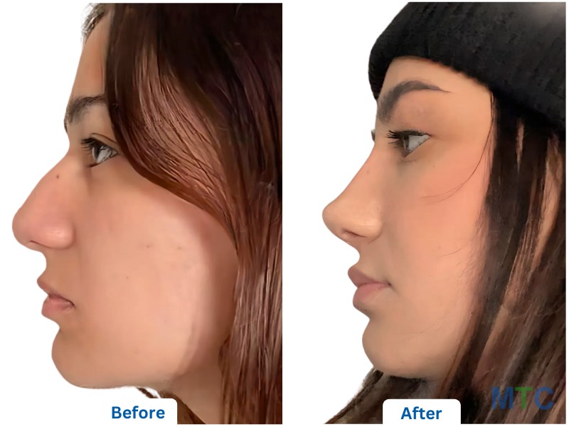 Rhinoplasty- Before and After