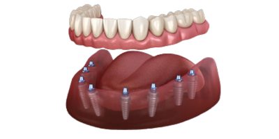 All on 8 Dental Implants