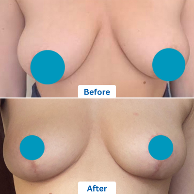 before and after images of a breast augmentation surgery