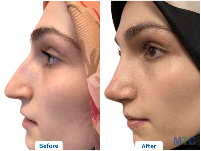 Rhinoplasty- Before and After