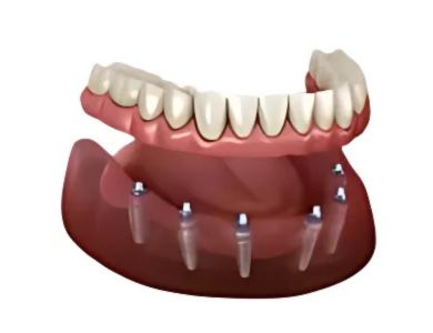 3-on-6 dental implants