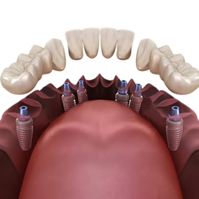 3 on 6 Dental Implants