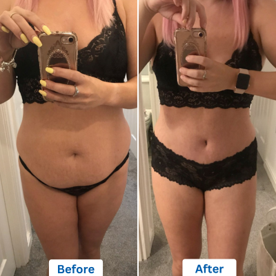 before and after images of a woman wearing black lingerie with left image being before and right image being after surgery