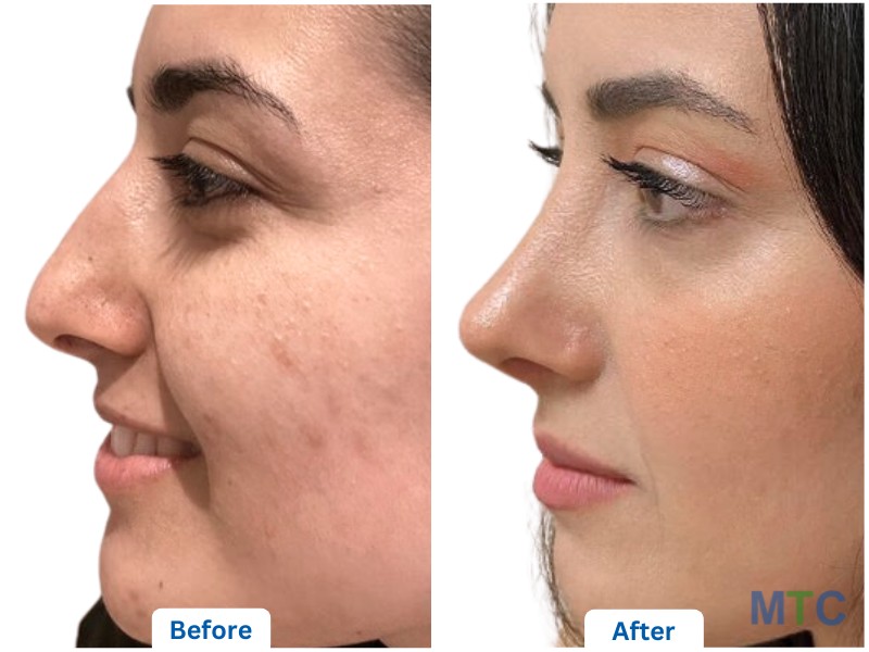 Rhinoplasty- Before and After