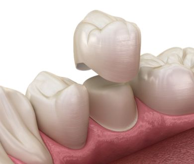 Dental Crowns