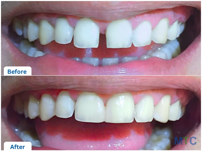 composite veneers