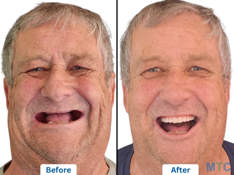 A Happy & Satisfied Patient After Full Mouth Dental Implants in Delhi