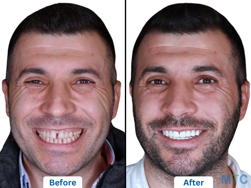 Increasing Longevity of Natural Teeth With Dental Crowns in Delhi