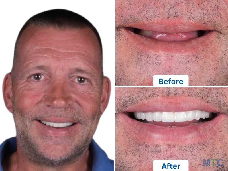 All on 4 Dental Implants