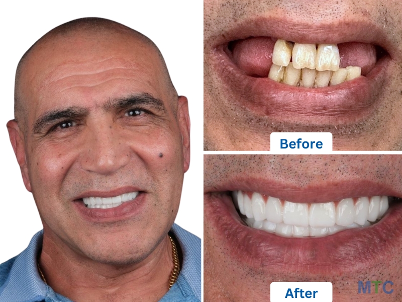 All on 4 Dental Implants