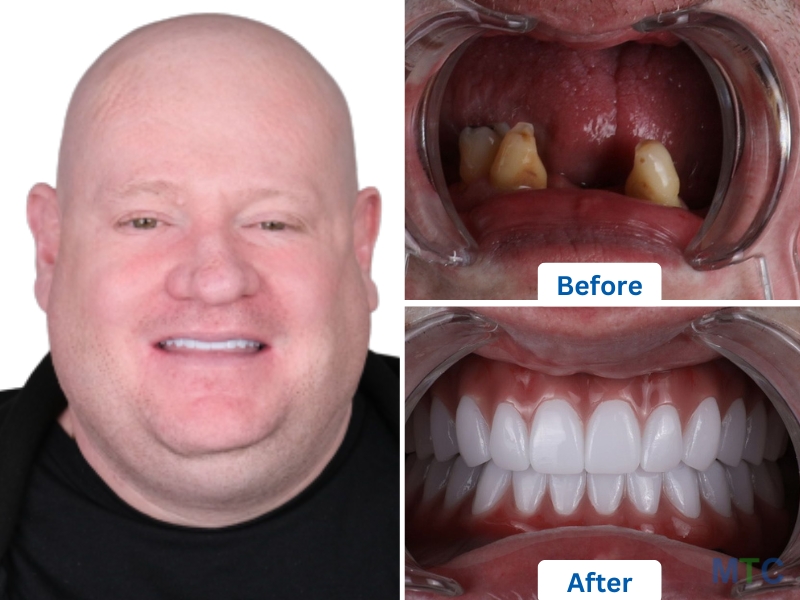 All on 4 Dental Implants