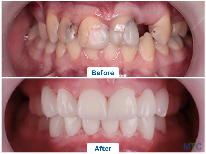 Dental Crowns