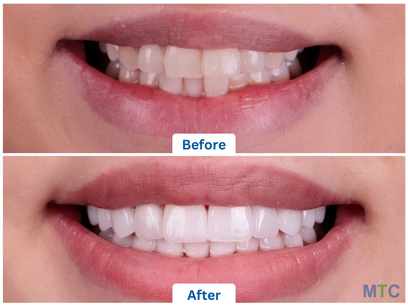 Dental Veneers