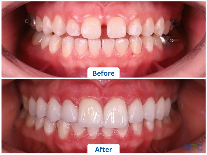 Dental Veneers