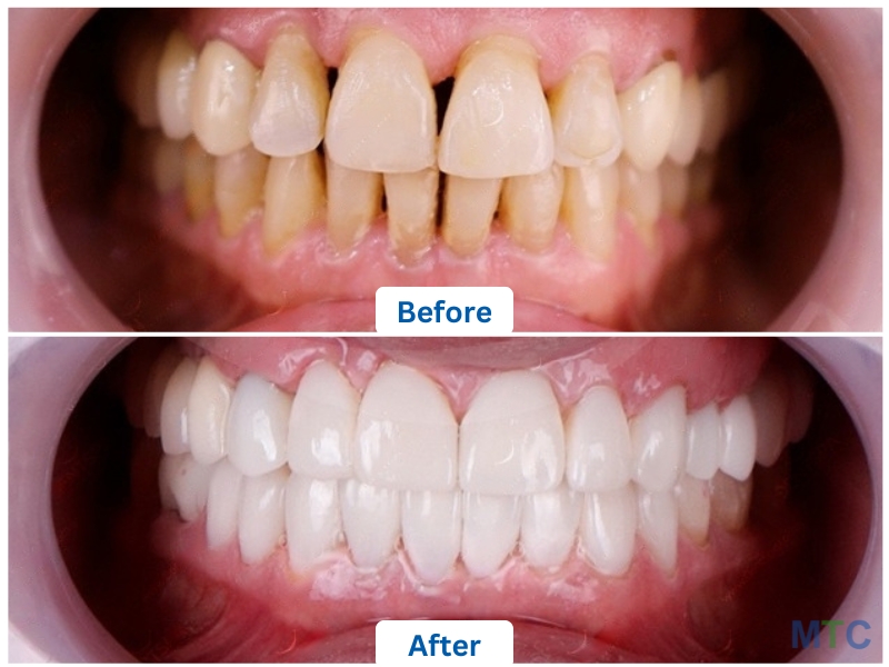 Dental Crowns