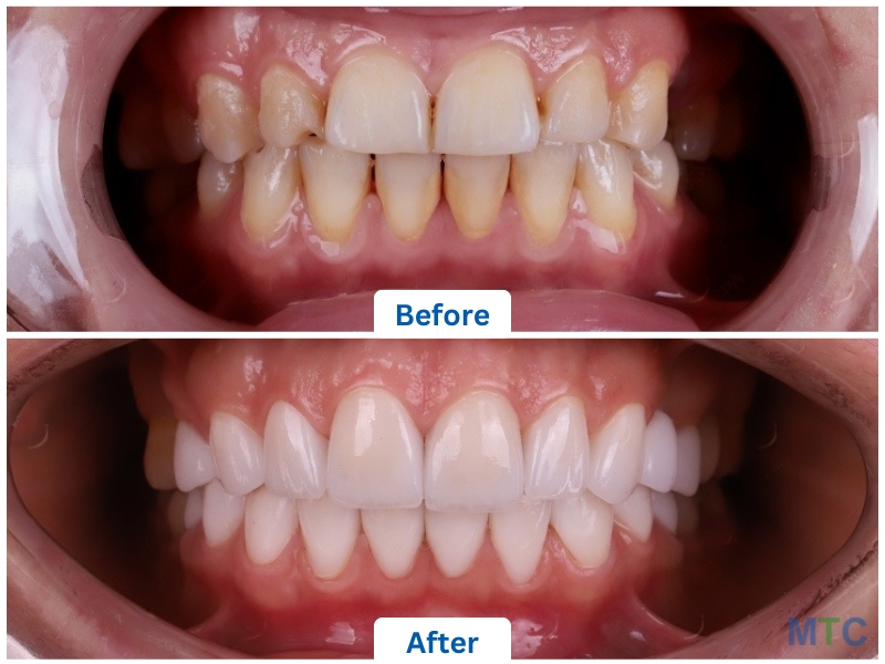 Dental Veneers