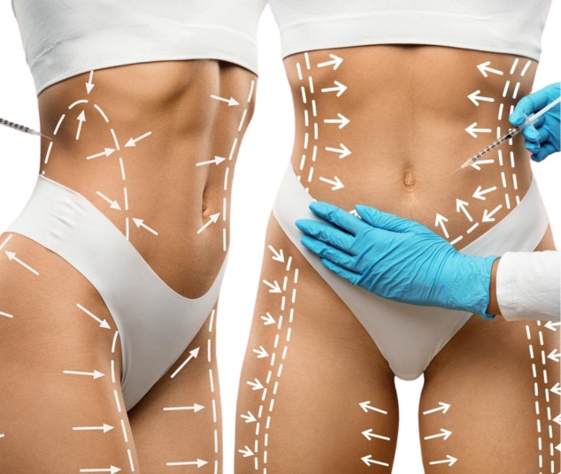 tummy tuck with lipo