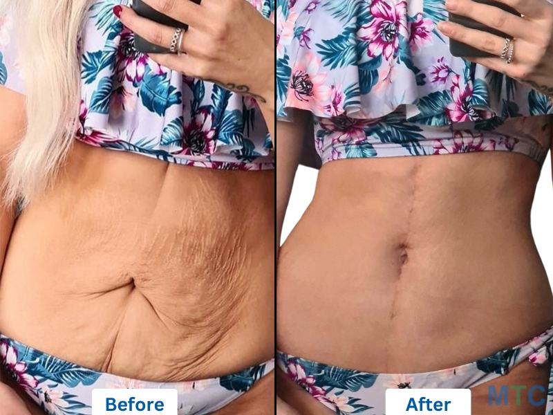 Before and after images of a woman who went through an FDL tummy tuck and breast lift with implants.