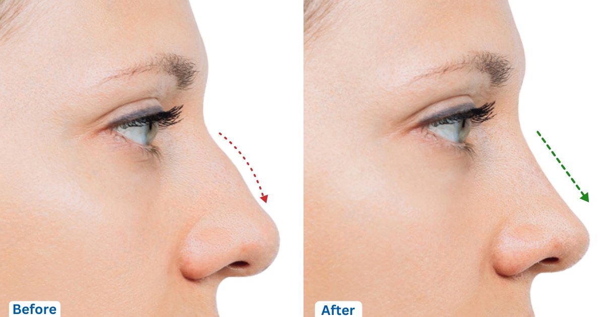 Caucasian Rhinoplasty in Turkey