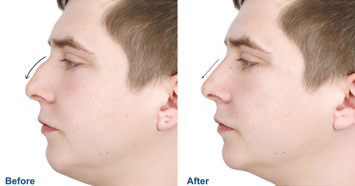 Male Rhinoplasty in Vietnam