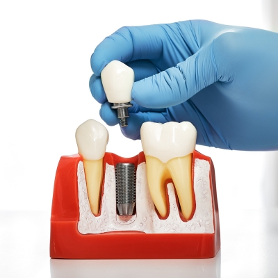 Dental Implants