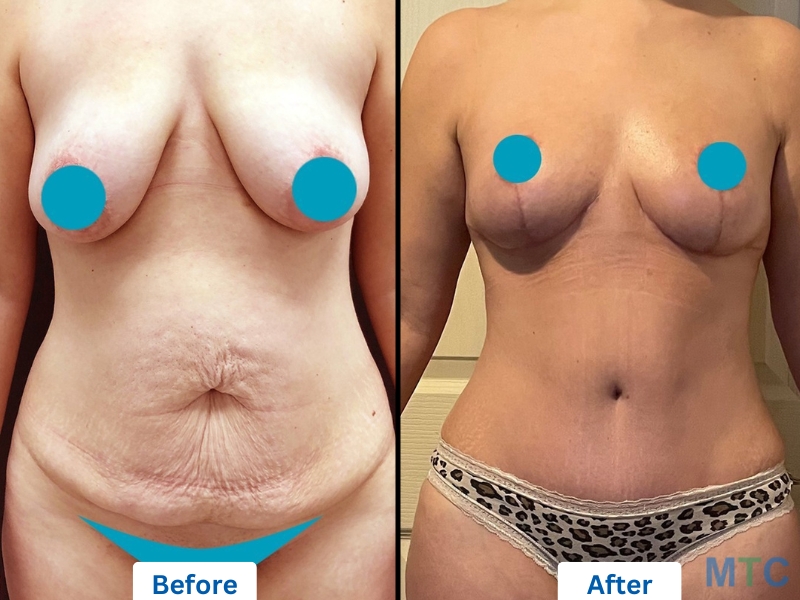 A before and after image of a woman with a tummy tuck, waist and bra zone liposuction, and breast lift.