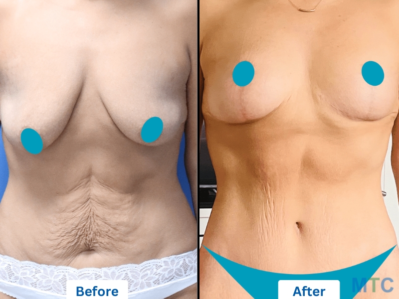 A before and after image of a woman with an extended tummy tuck, waist liposuction, and breast lift.