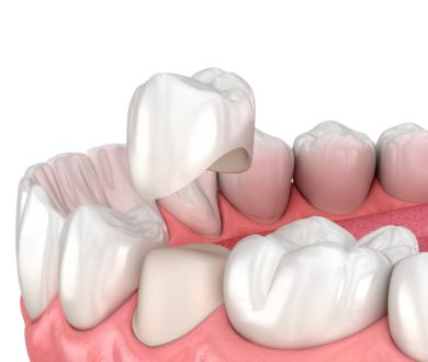 Percolain crowns for implants