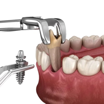 Tooth Extraction