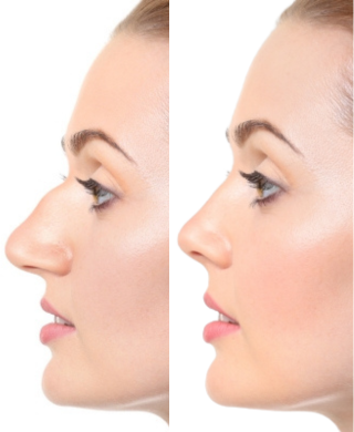 Rhinoplasty