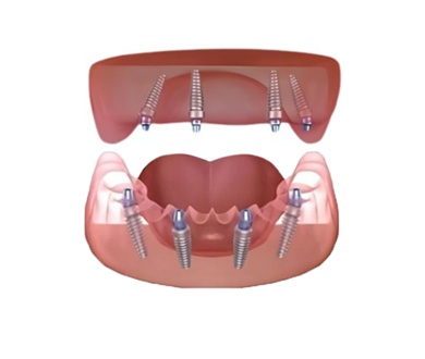 Diagrammatic representation of all on 4 dental implants in upper and lower jaw