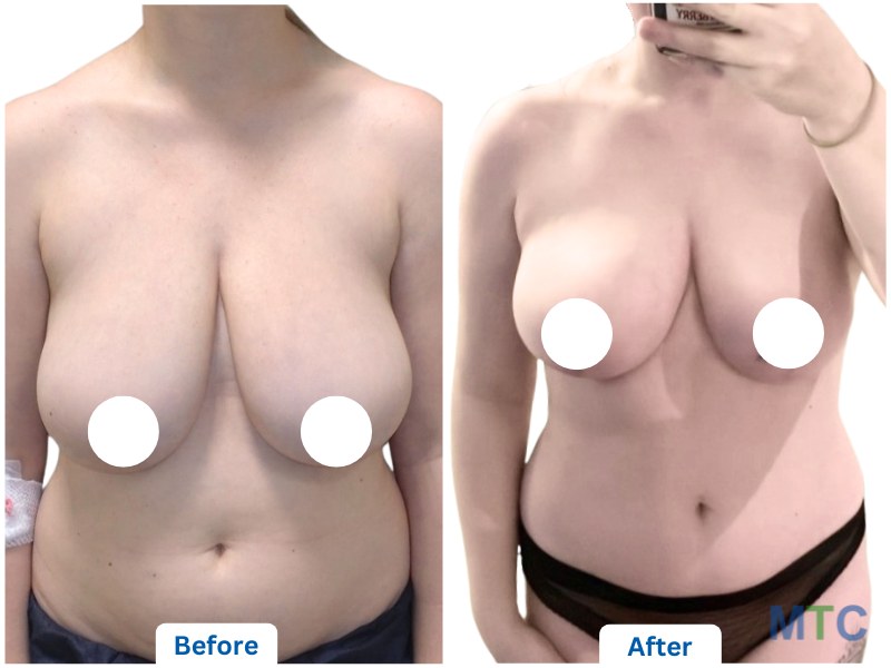 Before and after image of breast lift surgery in KCM Clinic, Poland