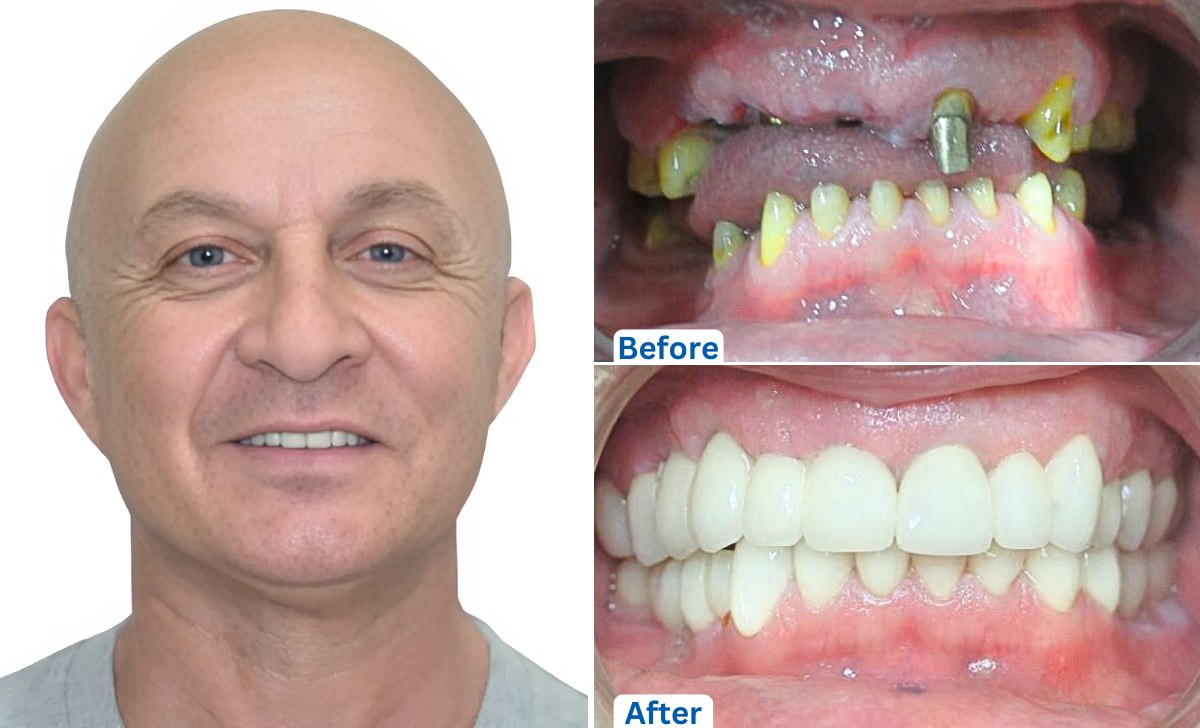 Dental Implants in Mumbai, India