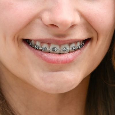 women wearing dental braces