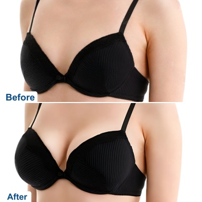 Before after images of breast augmentation