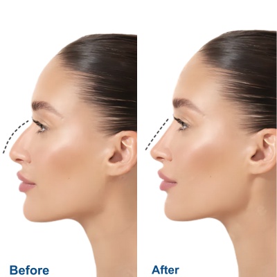 Before after images of rhinoplasty