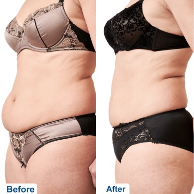 Before after images of tummy tuck