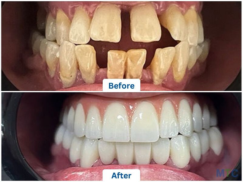 Dental Implants